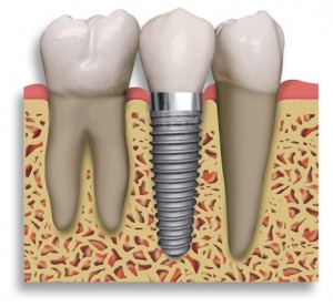 implantes dentales